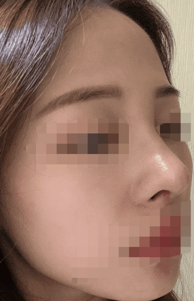 환자수술후기 — 점점 자연스러워져서 좋아요 ㅎㅎㅎㅎ