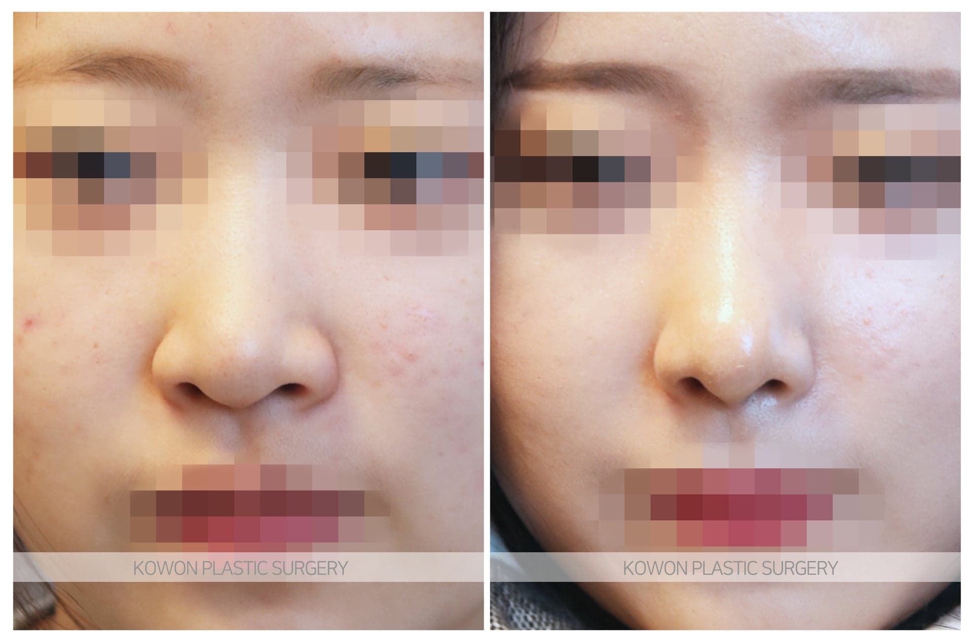 복코_용코/콧대가 낮은코 수술 전 사진 — 로그인 후 열람