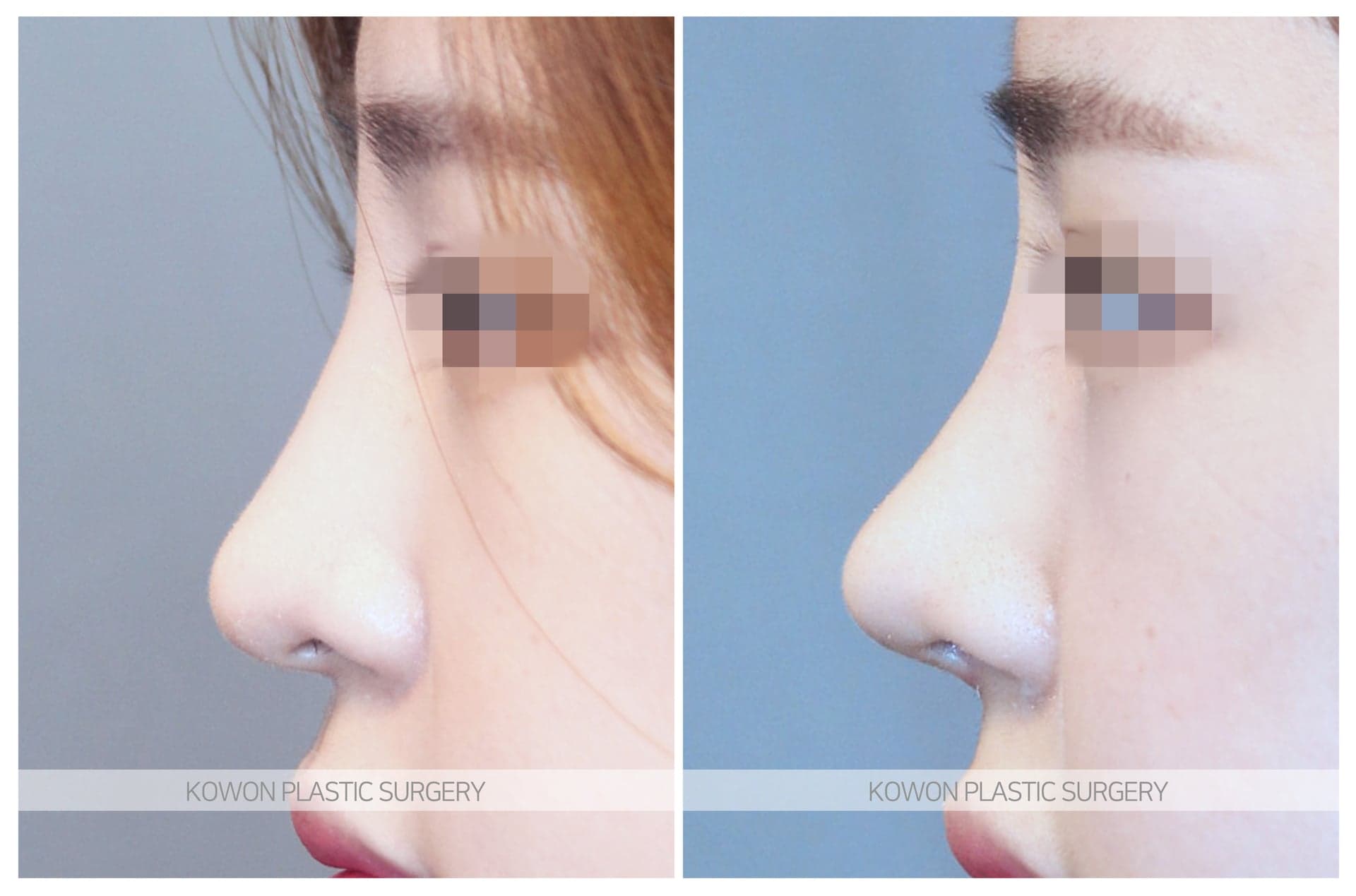 복코_긴코 수술 전 사진 — 로그인 후 열람
