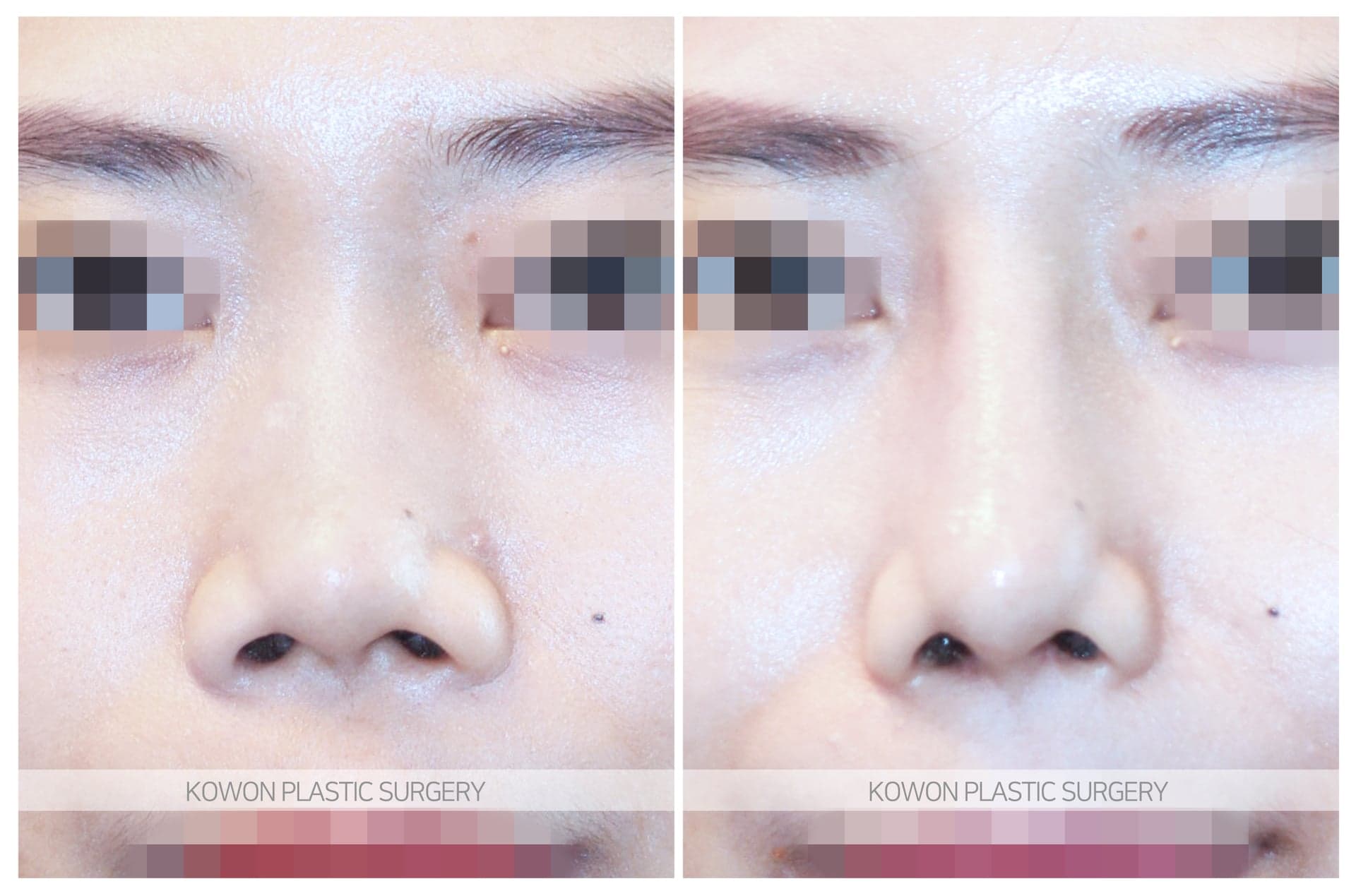 복코_콧날개가 넓은코/낮은코 수술 전 사진 — 로그인 후 열람
