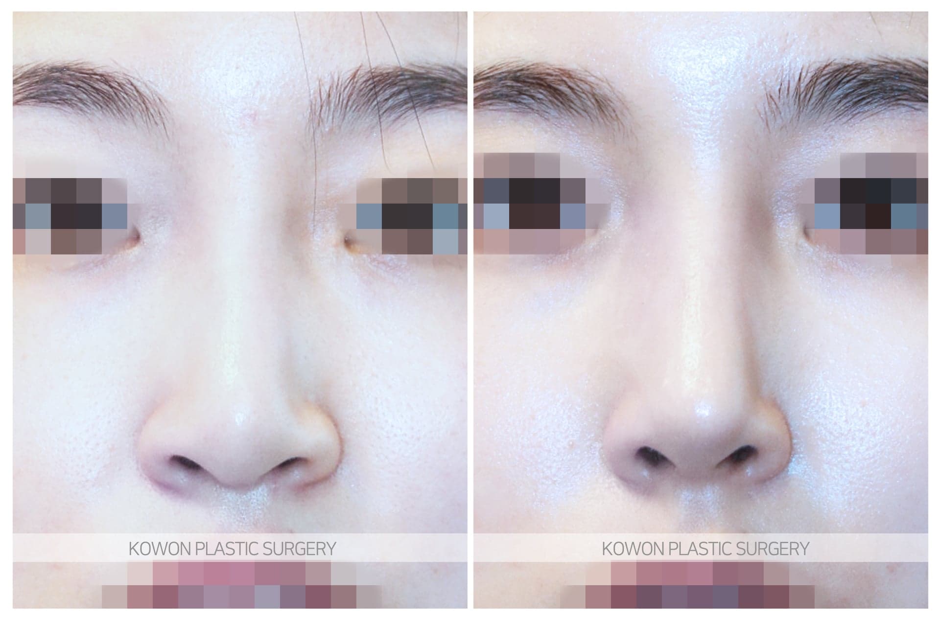 긴코_용코 수술 전 사진 — 로그인 후 열람