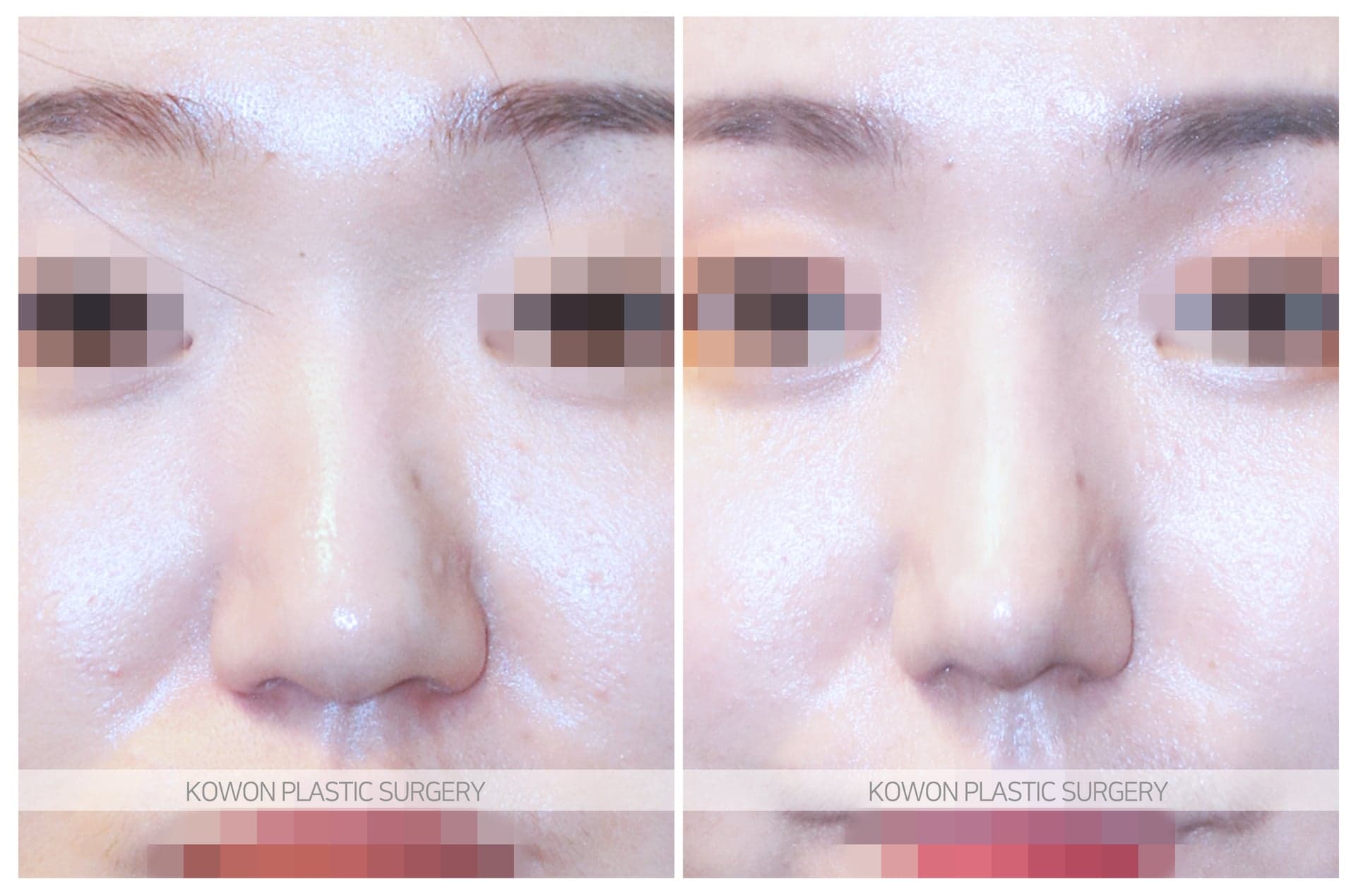 긴코_코끝이 내려간 코 수술 전 사진 — 로그인 후 열람