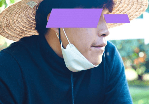 너무 마음에 들어요 수술후기 사진 2