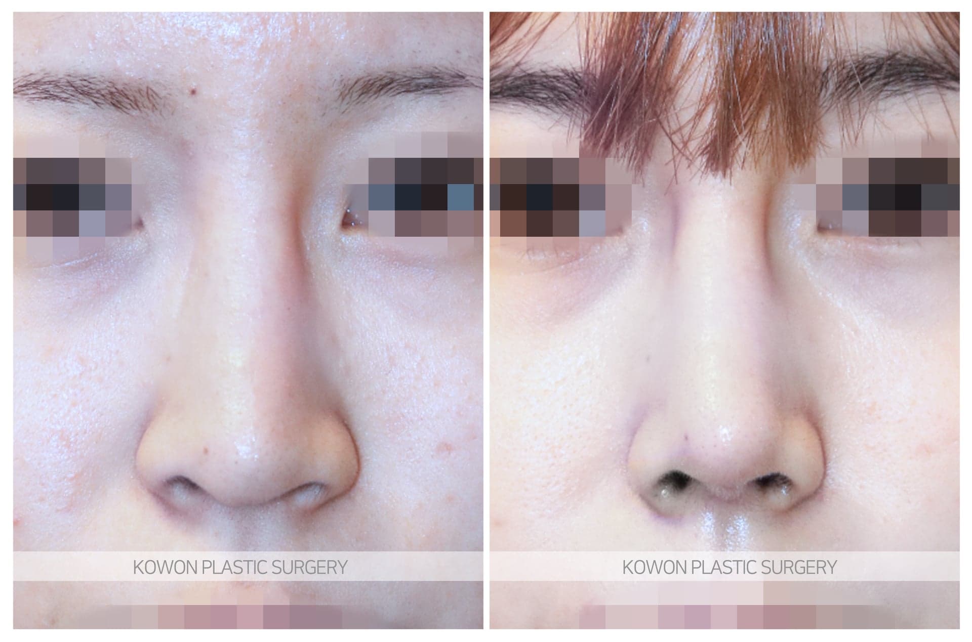 긴코_콧볼이 넓은코/코끝이 내려간 코 수술 전 사진 — 로그인 후 열람
