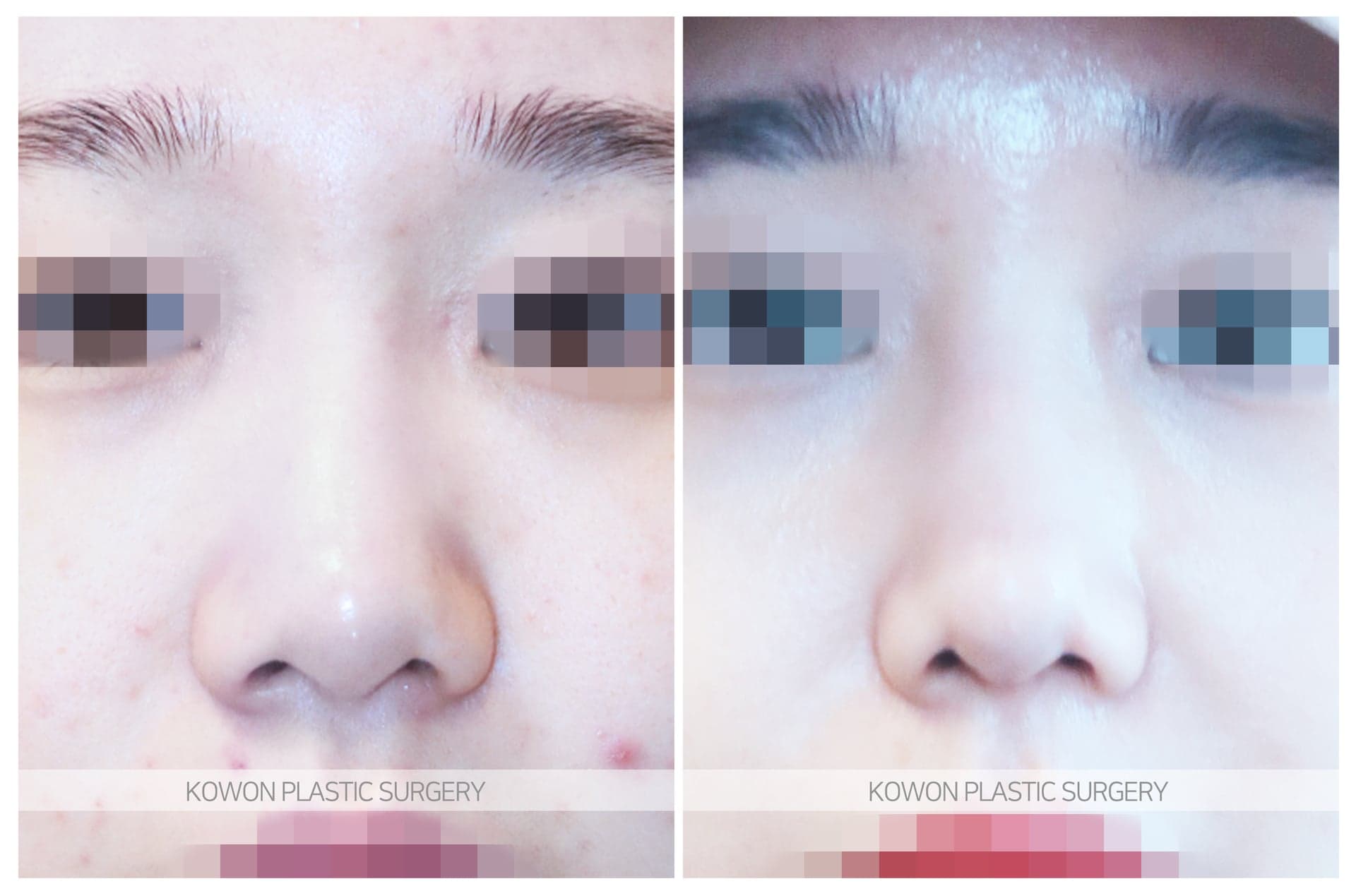 긴코_낮은코/복코 수술 전 사진 — 로그인 후 열람