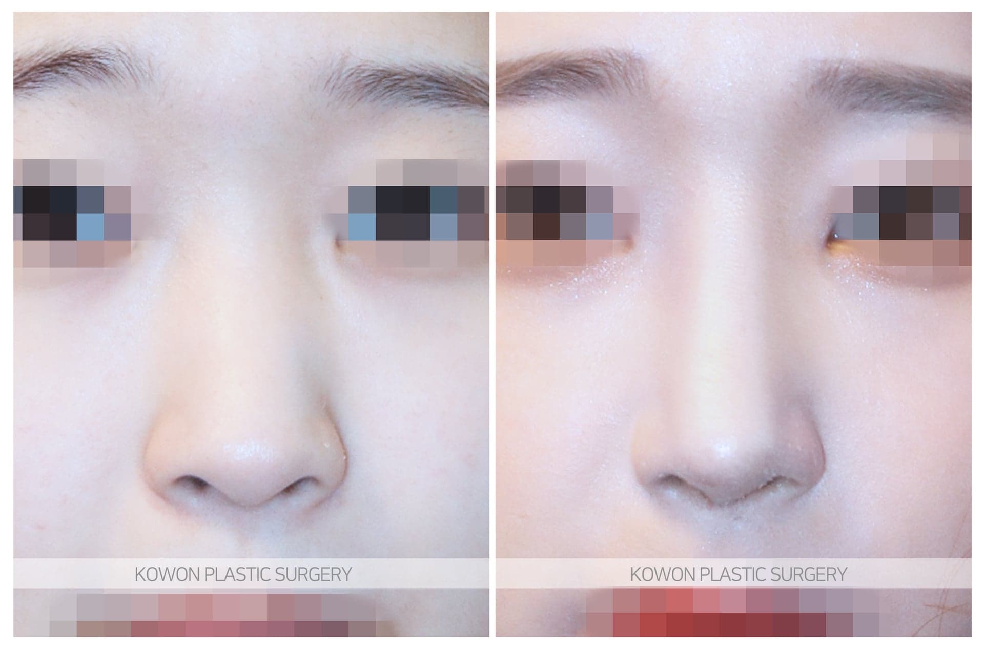 긴코_낮은코/코끝이 뭉툭한 코 수술 전 사진 — 로그인 후 열람