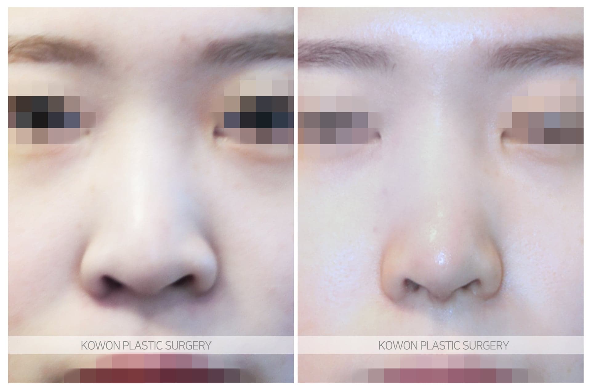 긴코_콧볼이 넓은코/낮은코 수술 전 사진 — 로그인 후 열람