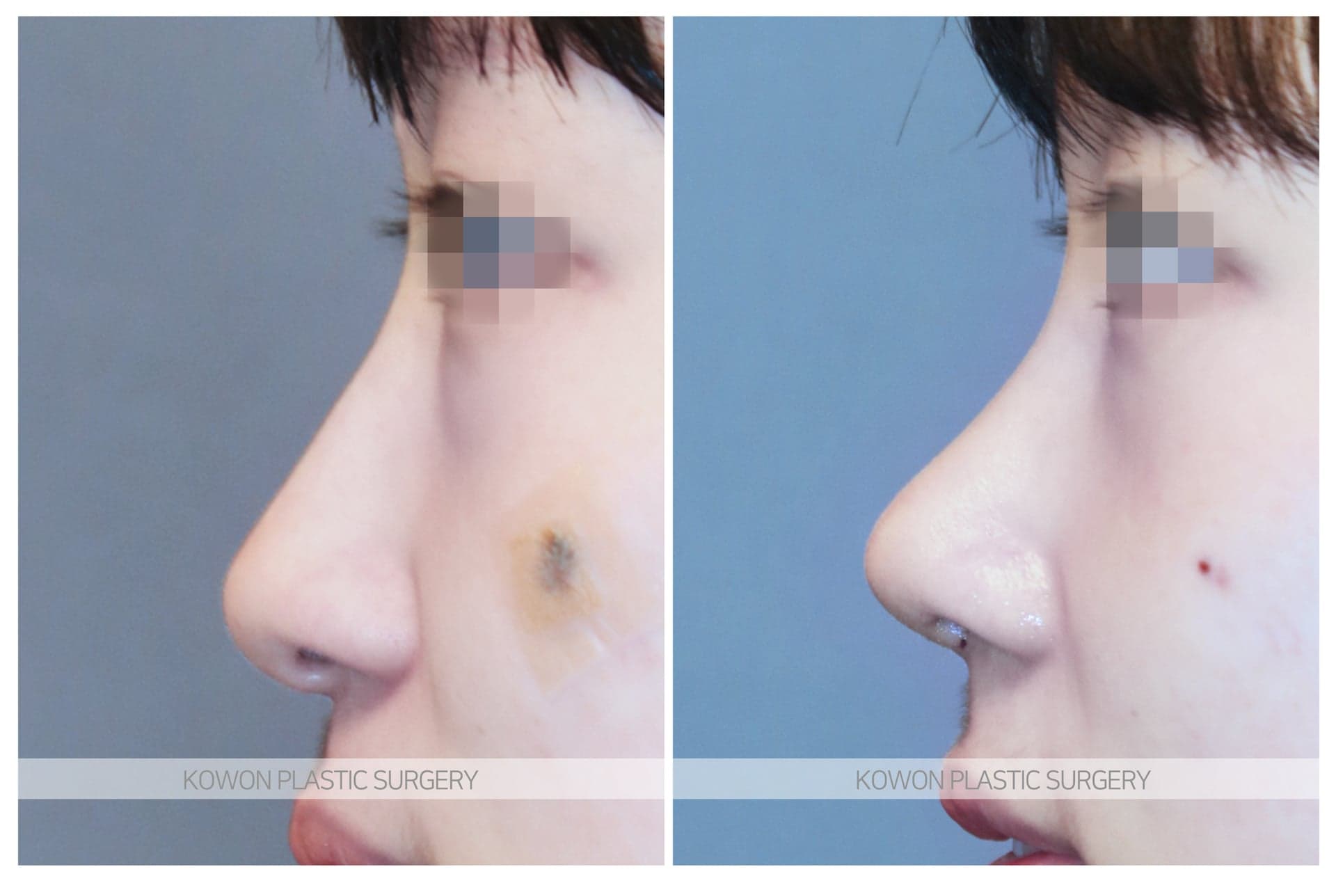 코재수술_코끝이 내려간 코 수술 전 사진 — 로그인 후 열람