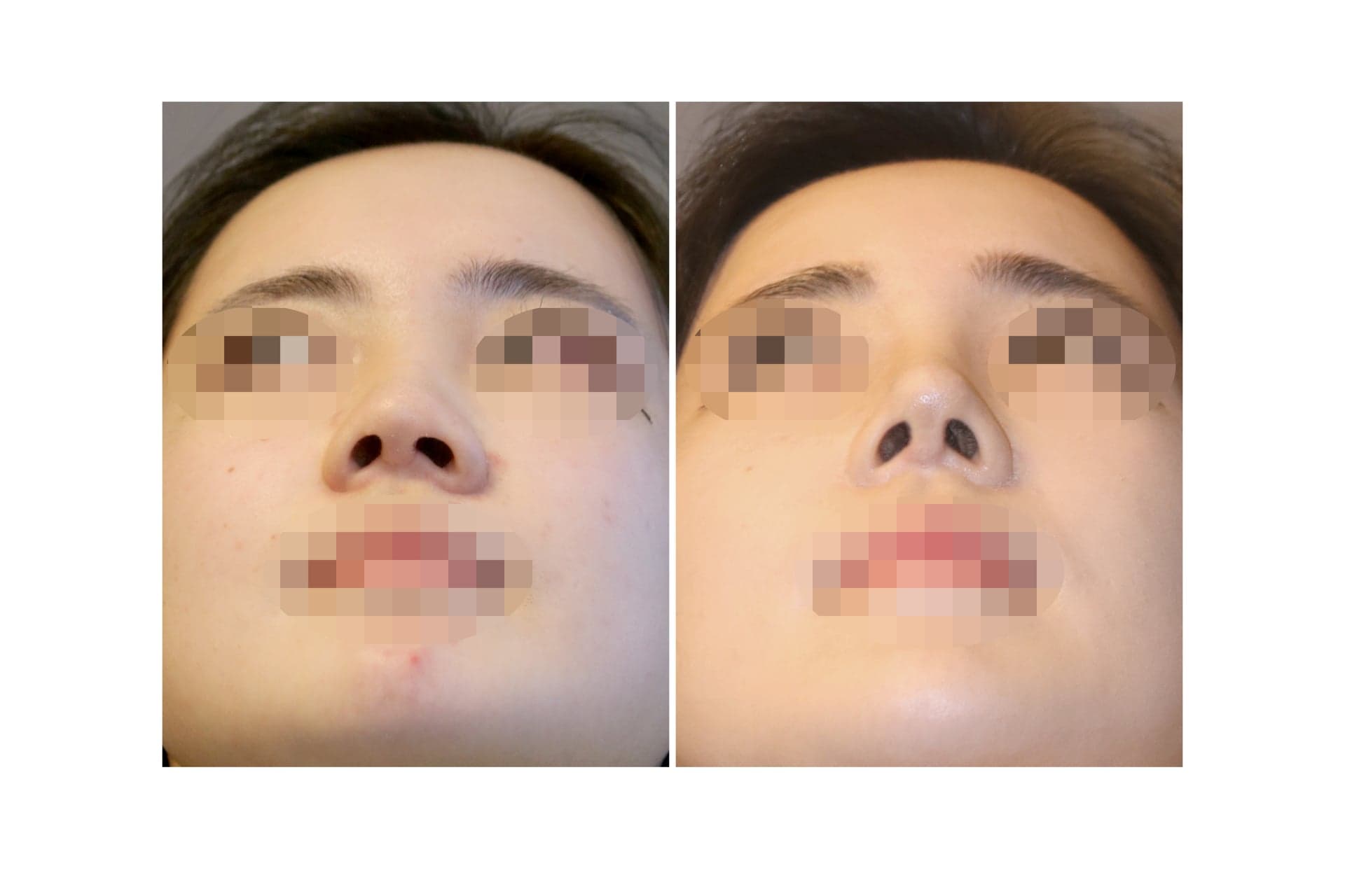 코재수술_복코 수술 전 사진 — 로그인 후 열람