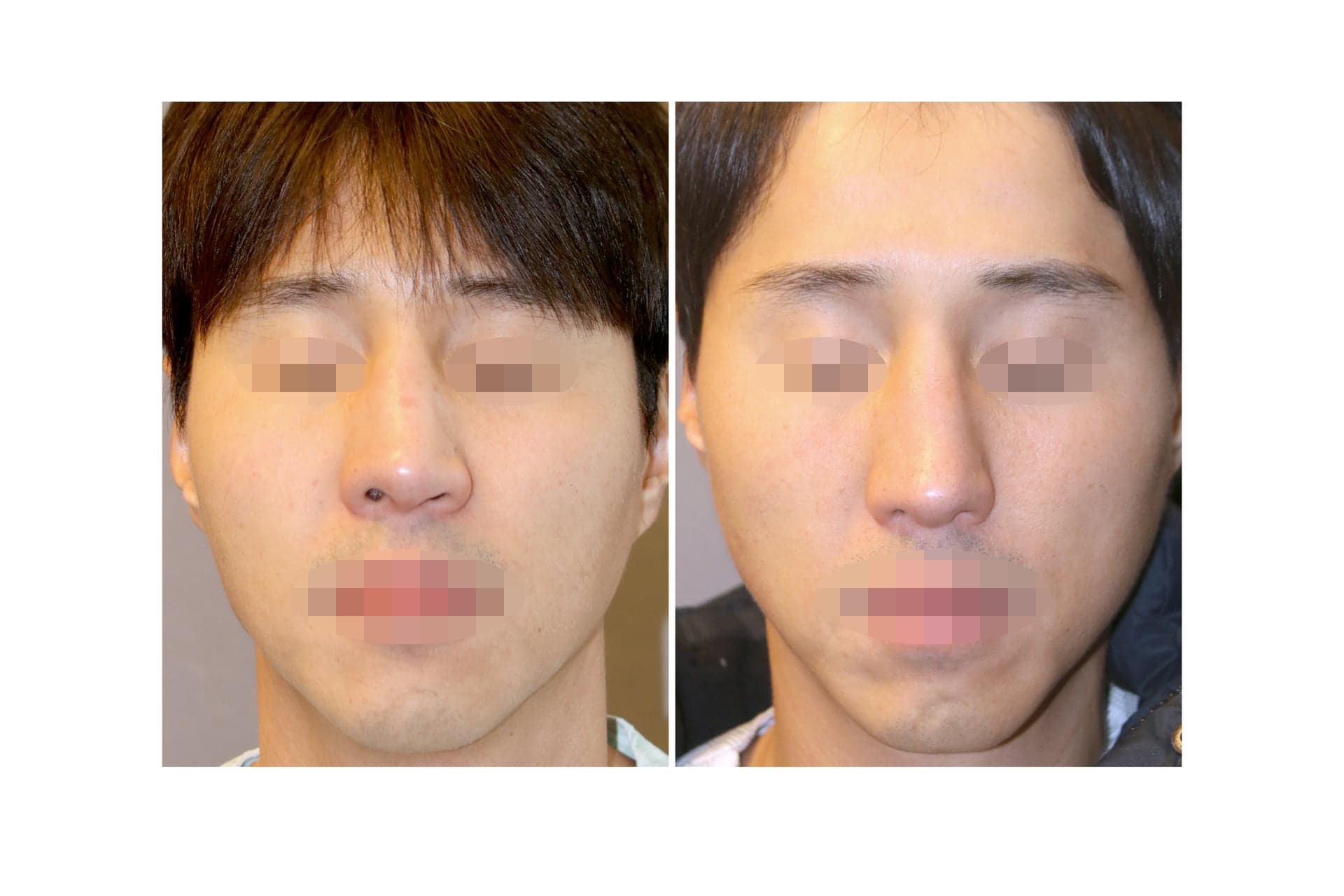 코재수술_복코 수술 전 사진 — 로그인 후 열람