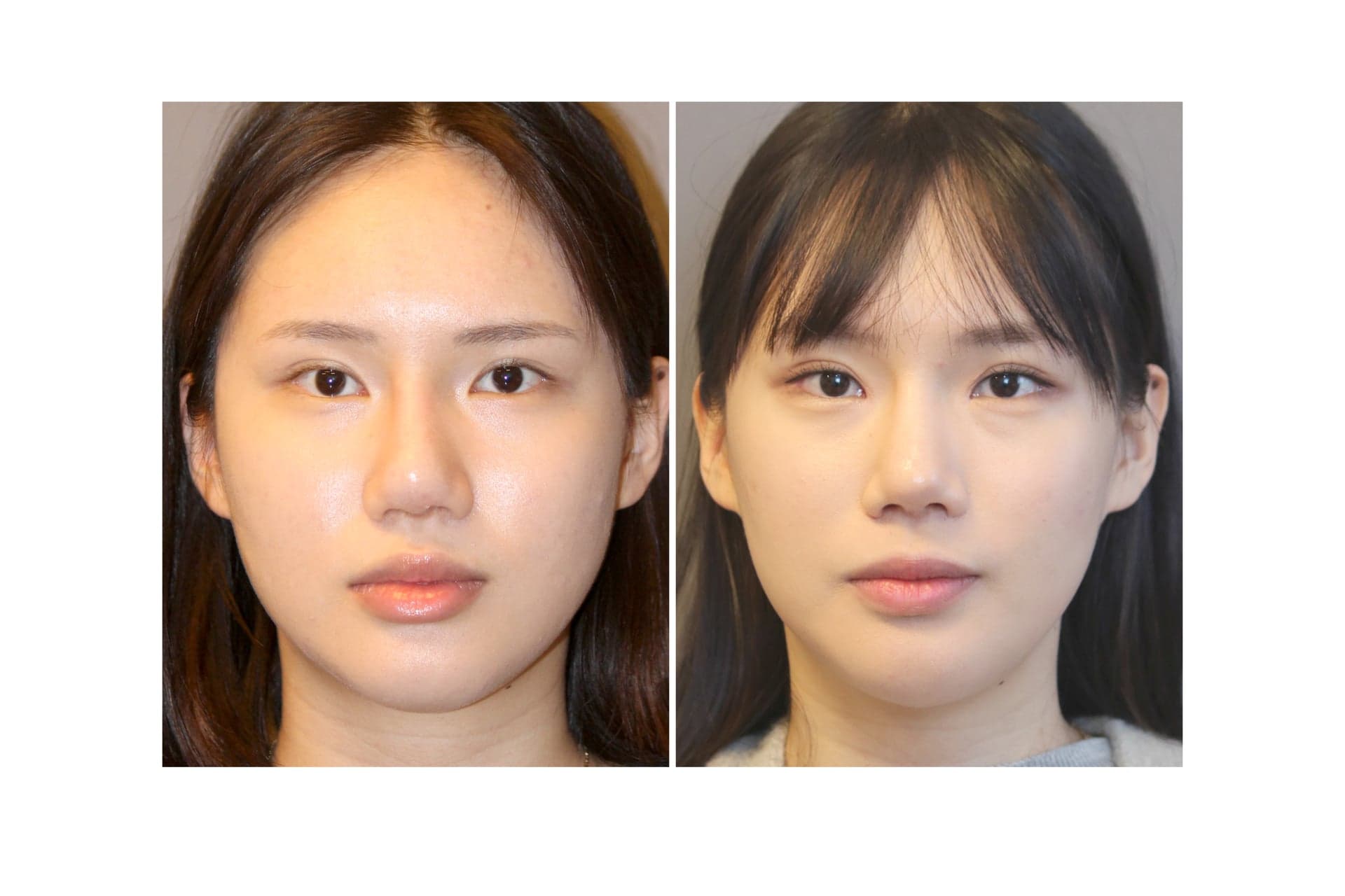 코재수술_복코 수술 전 사진 — 로그인 후 열람
