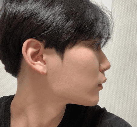 환자수술후기 — 후회 절대 안하는게 너무 좋습니다