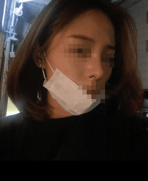환자수술후기 — 코수술 한지 한달차 입니당 ㅎㅎ