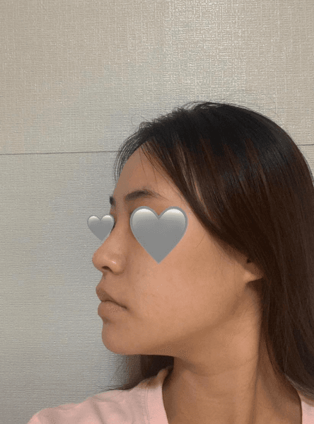후회 없는 수술 에요 ♥ 수술후기 사진 6