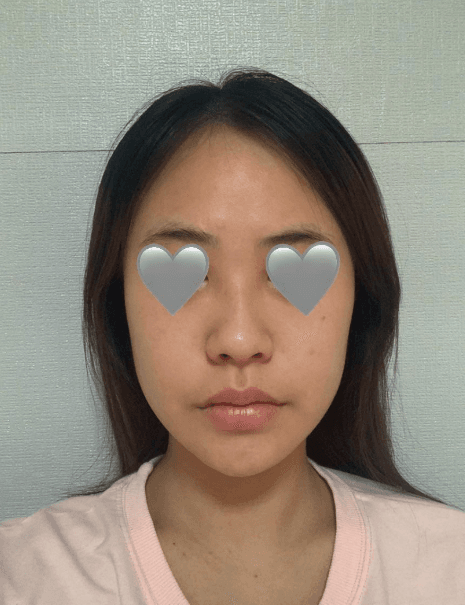 후회 없는 수술 에요 ♥ 수술후기 사진 7