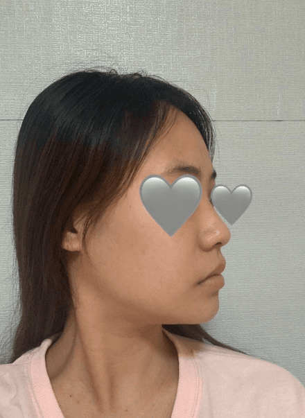 후회 없는 수술 에요 ♥ 수술후기 사진 8