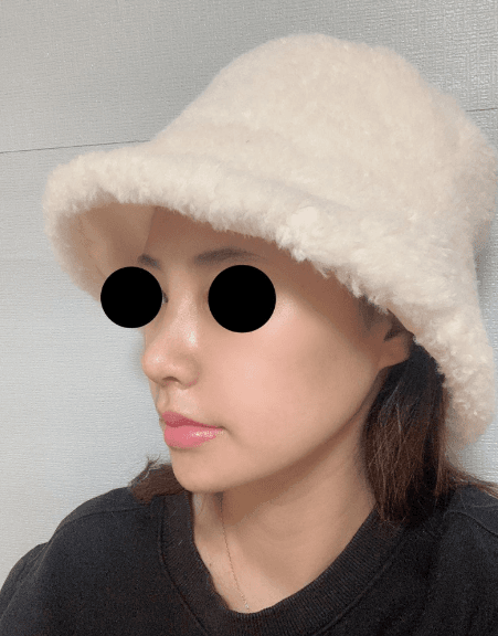 후회 없는 수술 에요 ♥ 수술후기 사진 2