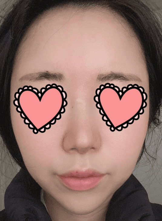 코원으로 달려가라고 추천했습니다 ㅎㅎㅎ♥ 수술후기 사진 2