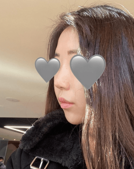 코원으로 달려가라고 추천했습니다 ㅎㅎㅎ♥ 수술후기 사진 3