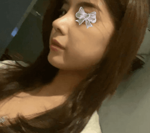 환자수술후기 — 주변에서도 다들 잘됐다고 난리네요!