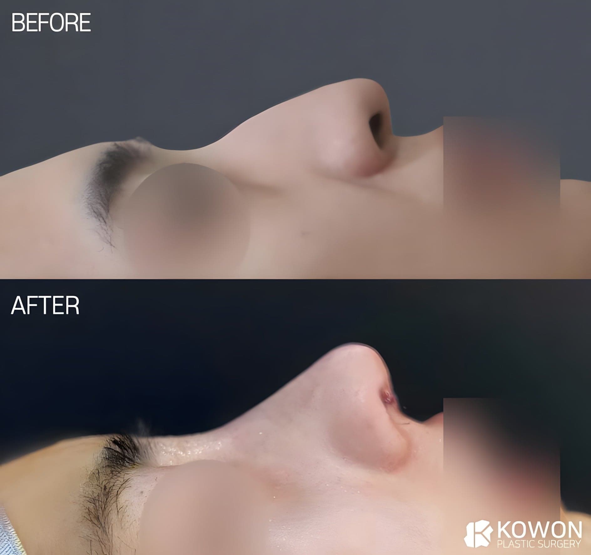 남자코·매부리코 개선 코수술 전후사진(수술 직후)
