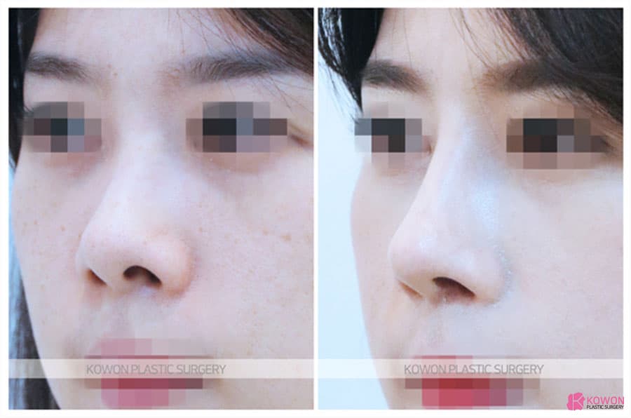여자코수술로 개선한 콧구멍 짝짝이 교정 사례, 코재수술 고려 포인트 정리 — rhinoplasty information image