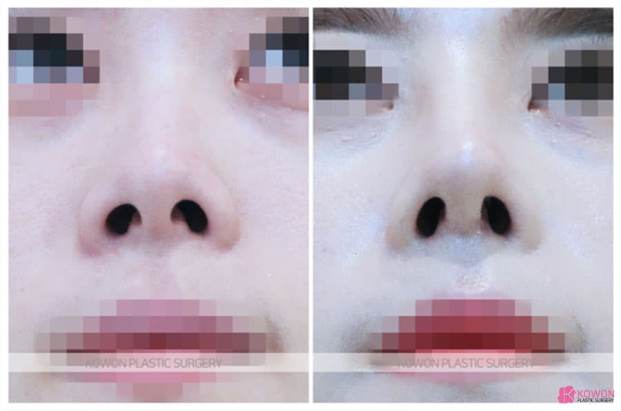 여자코수술로 개선한 콧구멍 짝짝이 교정 사례, 코재수술 고려 포인트 정리 — 코성형 정보 이미지