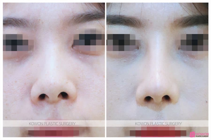 여자코수술로 개선한 콧구멍 짝짝이 교정 사례, 코재수술 고려 포인트 정리 — 코성형 정보 이미지