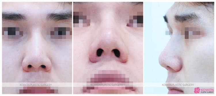 코재수술로 완성한 낮은코성형 변화 과정과 실제 코성형후기 정리 — 코성형 정보 이미지