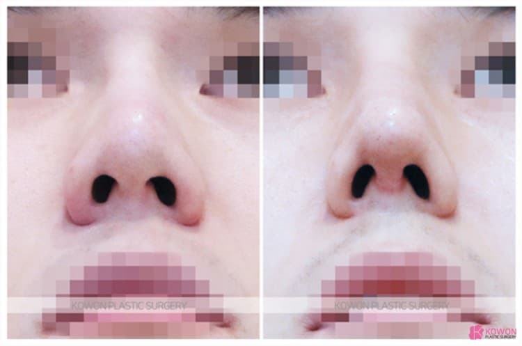 코재수술로 완성한 낮은코성형 변화 과정과 실제 코성형후기 정리 — 코성형 정보 이미지
