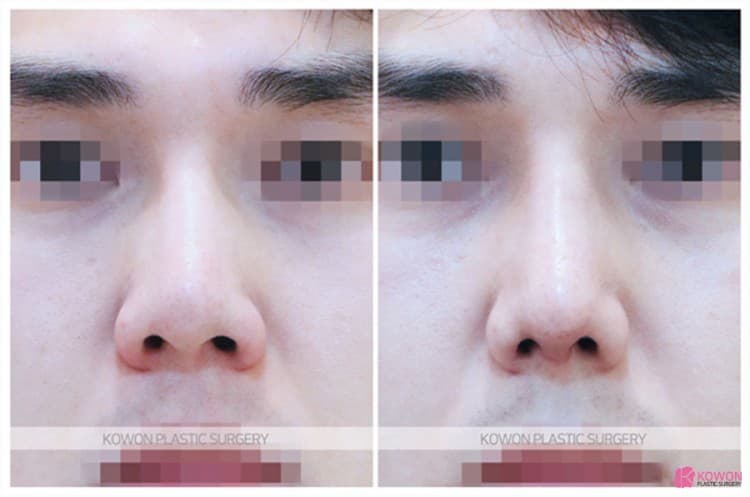 코재수술로 완성한 낮은코성형 변화 과정과 실제 코성형후기 정리 — 코성형 정보 이미지