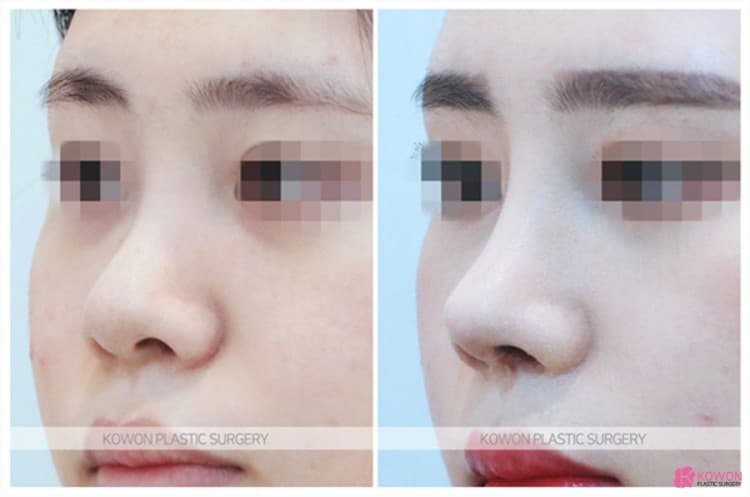 코성형잘하는곳 선택 기준, 비중격연장과 복코수술 전후 변화 과정 정리 — rhinoplasty information image