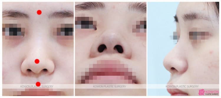 코성형잘하는곳 선택 기준, 비중격연장과 복코수술 전후 변화 과정 정리 — 코성형 정보 이미지
