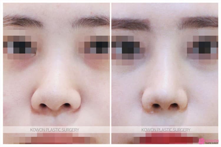 코성형잘하는곳 선택 기준, 비중격연장과 복코수술 전후 변화 과정 정리 — 코성형 정보 이미지