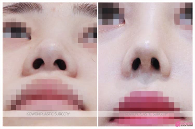 코성형잘하는곳 선택 기준, 비중격연장과 복코수술 전후 변화 과정 정리 — 코성형 정보 이미지