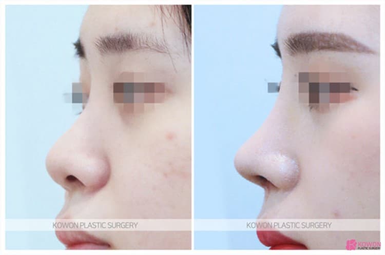 코성형잘하는곳 선택 기준, 비중격연장과 복코수술 전후 변화 과정 정리 — 코성형 정보 이미지