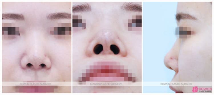 코재수술로 개선한 콧등요철 사례, 여자코성형 변화 과정 알아보자 — 코성형 정보 이미지