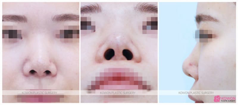 자가늑코수술로 진행한 코재수술후기, 매부리코교정 변화 과정 정리 — 코성형 정보 이미지