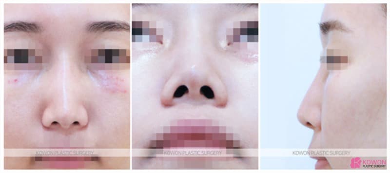 코필러제거 후 진행한 콧대수술, 자연스러운 코성형전후 변화 사례 — 코성형 정보 이미지