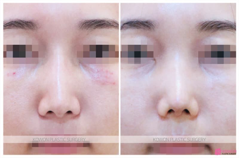 코필러제거 후 진행한 콧대수술, 자연스러운 코성형전후 변화 사례 — 코성형 정보 이미지