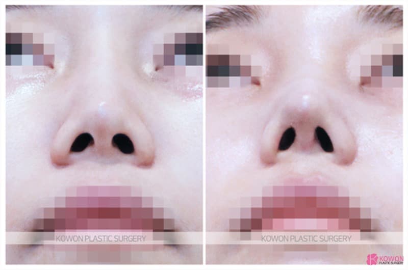 코필러제거 후 진행한 콧대수술, 자연스러운 코성형전후 변화 사례 — 코성형 정보 이미지