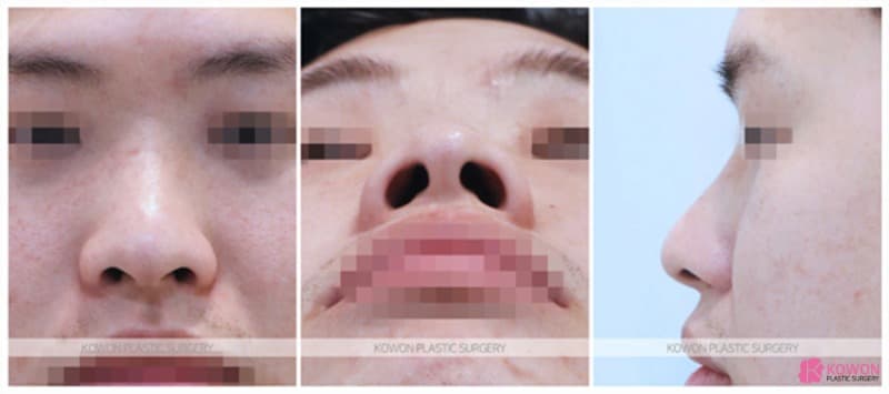 콧볼축소수술과 남자코성형으로 달라진 인상, 자연스러운 코수술후기 사례 — 코성형 정보 이미지
