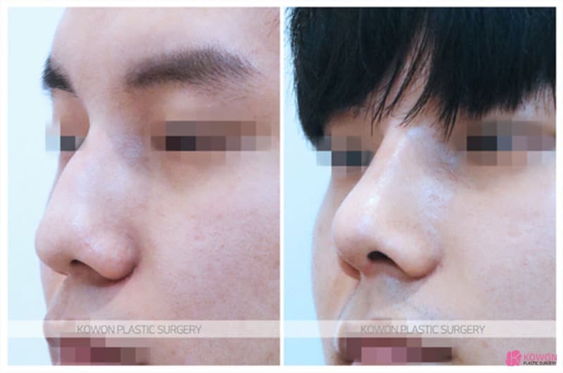 비중격만곡증과 매부리코수술, 복코수술까지 함께 진행한 남자 코 변화 사례 — rhinoplasty information image