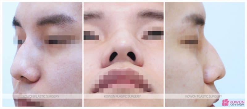 비중격만곡증과 매부리코수술, 복코수술까지 함께 진행한 남자 코 변화 사례 — 코성형 정보 이미지