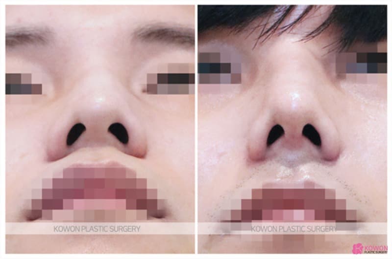 비중격만곡증과 매부리코수술, 복코수술까지 함께 진행한 남자 코 변화 사례 — 코성형 정보 이미지