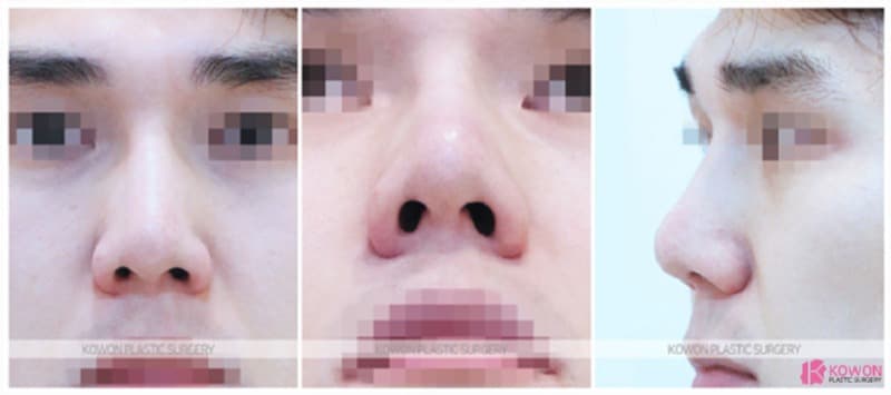 코재수술, 남자코수술과 낮은코성형으로 자연스러운 변화를 만든 사례 — 코성형 정보 이미지