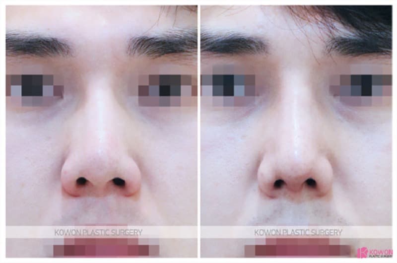 코재수술, 남자코수술과 낮은코성형으로 자연스러운 변화를 만든 사례 — 코성형 정보 이미지