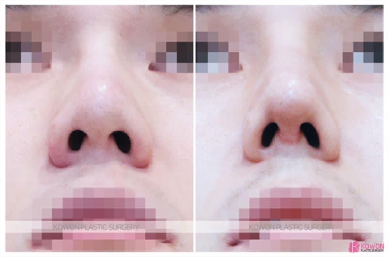 코재수술, 남자코수술과 낮은코성형으로 자연스러운 변화를 만든 사례 — 코성형 정보 이미지