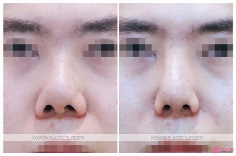 남자코성형과 코재수술, 비중격만곡증까지 함께 고려한 사례 — 코성형 정보 이미지