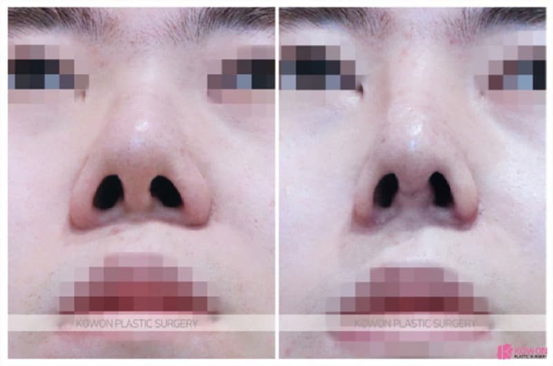 남자코성형과 코재수술, 비중격만곡증까지 함께 고려한 사례 — 코성형 정보 이미지